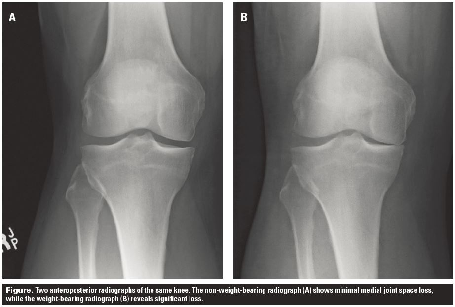 total-knee-replacement-understanding-patient-related-factors-british